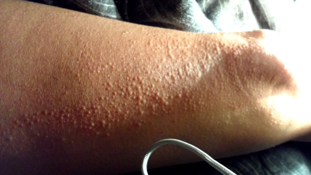 spreading-rash-goes-away-and-comes-back-skin-problems-treatments